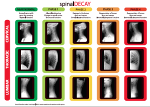 Spinal Decay Poster Example